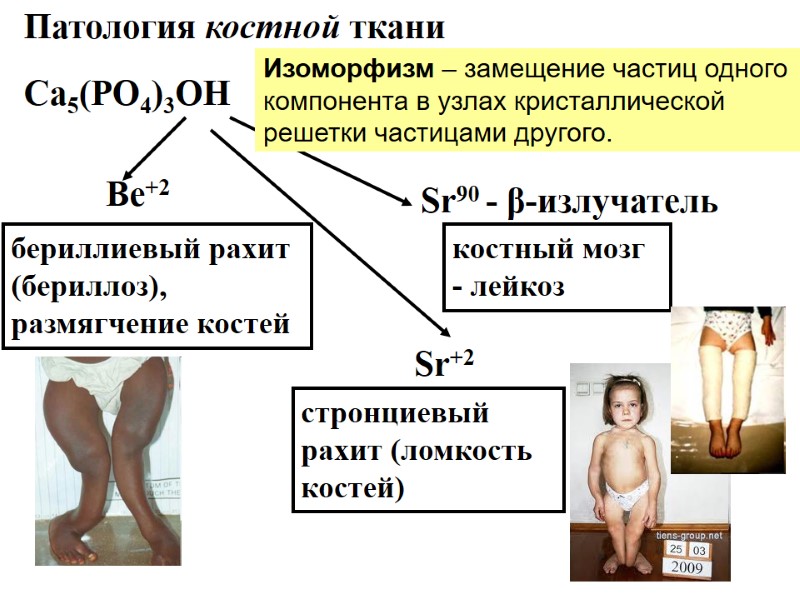 Патология костной ткани Са5(РО4)3ОН Ве+2 Sr+2 Sr90 - β-излучатель  бериллиевый рахит (бериллоз), размягчение